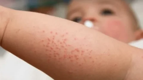 Escarlatina: é preciso conhecer para saber como e quando agir 2 Escarlatina: é preciso conhecer para saber como e quando agir