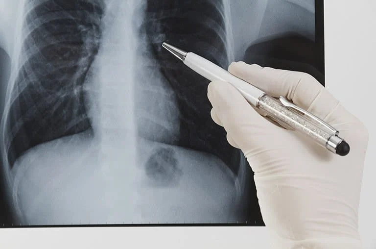 O Brasil está entre os 13 países que conseguiram recuperar a detecção de pessoas com tuberculose após a pandemia de covid-19, conforme