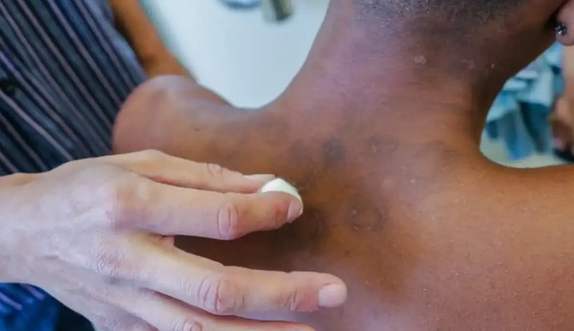 Hanseníase: pacientes contam histórias de preconceito e superação 1 Entre janeiro e novembro de 2023, o Brasil diagnosticou ao menos 19.219 novos casos de hanseníase