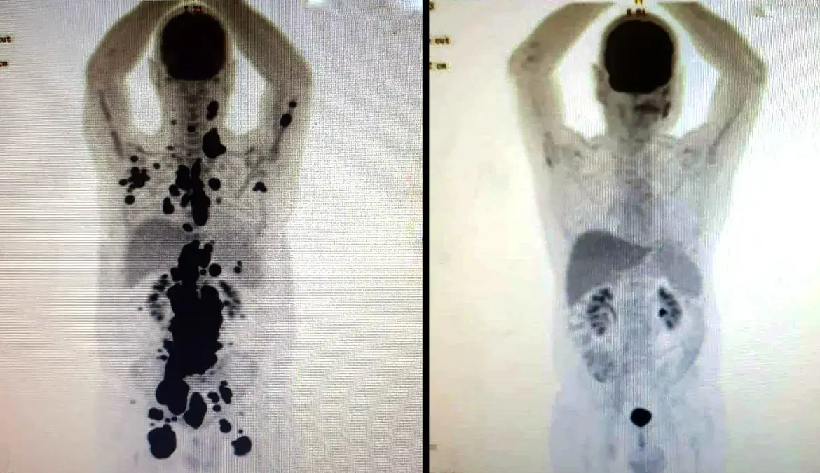 A terapia celular CAR-T Cell tem obtido resultado importante no tratamento de alguns tipos de câncer, por meio da reprogramação das células
