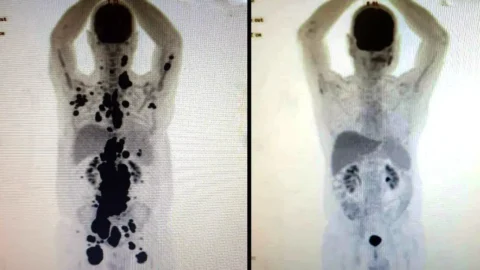 Entenda como funciona a terapia celular CAR-T Cell contra o câncer 1 Entenda como funciona a terapia celular CAR-T Cell contra o câncer
